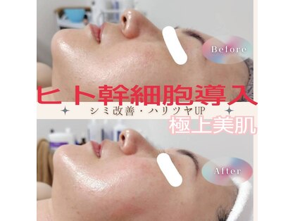 ビキャン(Can)の写真
