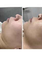 リグレア 新宿(Re.GLARE)/小顔リフト機器3種取扱い