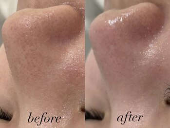 リスポアラボ(LIS PORE.LAB)/1回before after