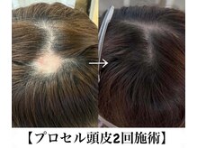 チル(Chill)の雰囲気（40代以降の女性に人気の頭皮ケアです。）