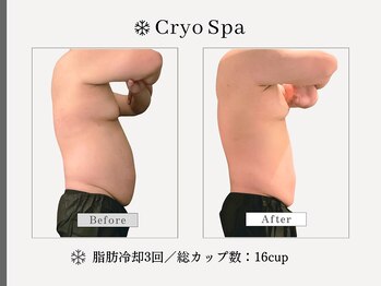 クリオスパ せんげん台駅前店(Cryo Spa)/脂肪冷却