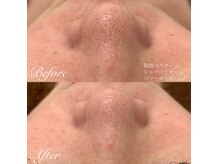 REVI陶肌トリートメント