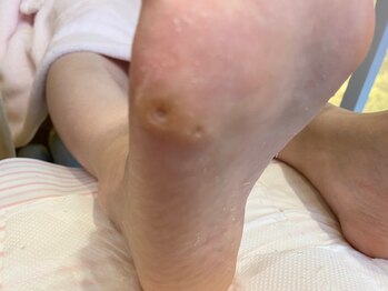 実績豊富なフットケア角質ケア-2
