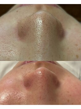 リオ(Lio)/ハイドラ