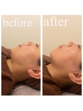 ディス イズ ミー エステティック(This is Me Aesthetic)/劇的リフトアップ