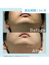 メンズクリア 柏店/【メンズクリア】お客様の施術例