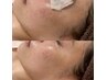 【短期間で変わりたい方必見！】1ヶ月で透明感あふれる水光肌へ＊初回体験
