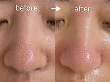 アルカンシエル(arcenciel)/毛穴改善コース