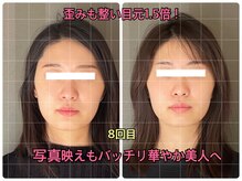 ソルビーフェイス(SOL*BeFace)の雰囲気（歪みも無くなり、ぱっちり目元に♪）