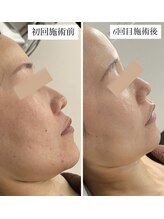 リノン(LINON) ハーブ ピーリング