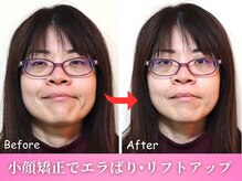 ワト(WATO)/■小顔施術（before→after)