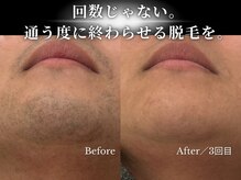 ダイヤ 名古屋中川区店(Daiya)/3回で濃かった髭が激変！あご下