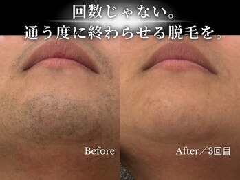 ダイヤ 名古屋中川区店(Daiya)/3回で濃かった髭が激変！あご下