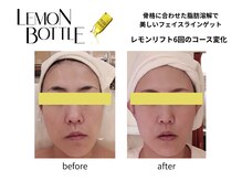 クリニカルエステ イーズ 小倉リバーウォーク北九州デコシティ店/FACEレモンボトル変化写真-1