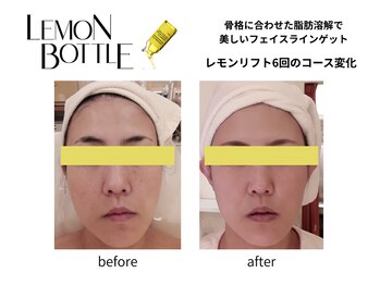 クリニカルエステ イーズ 小倉リバーウォーク北九州デコシティ店/FACEレモンボトル変化写真-1