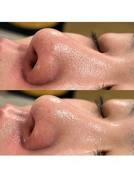 シンディー(CINDY)/毛穴洗浄