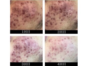 ミミー/4回の変化