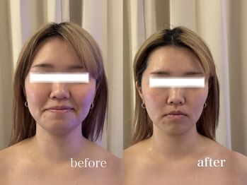 アルテ 神戸(Arte)の写真/【 結果重視 】フェイスラインを引き締めて理想の小顔へ