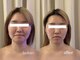 アルテ 神戸(Arte)の写真/【 結果重視 】フェイスラインを引き締めて理想の小顔へ