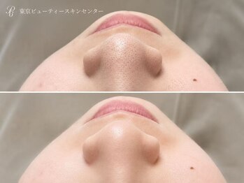 東京ビューティースキンセンター 新宿店/ハイドラ毛穴洗浄