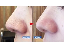 ニュイブラーシュ(nuit blanche)/小鼻の毛穴黒ずみも♪