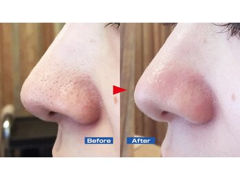 ニュイブラーシュ(nuit blanche)/小鼻の毛穴黒ずみも♪