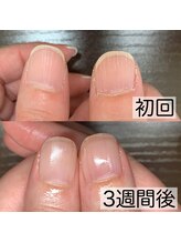 アカツキネイル(Akatsuki Nail)/爪育成