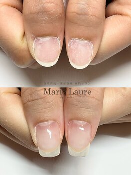 マリーロール 梅田店(Marie Laure)/自爪育成/深爪矯正/ネイルケア