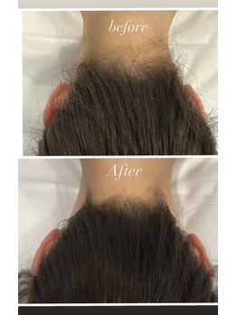 グレースビューティ(gracebeauty)/うなじと背中脱毛