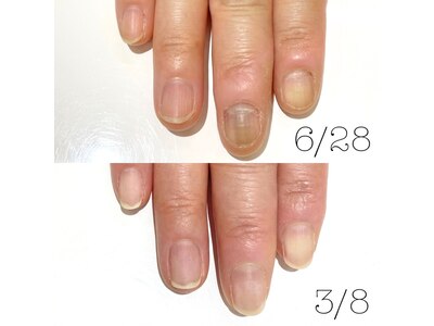 爪育ジェルを約8ヶ月で、変色改善、お爪の形も縦長美人爪に♪
