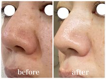 ルー ハナレ 神戸岡本 摂津本山店(Luu HANARE)/4回小顔シミ改善・毛穴改善