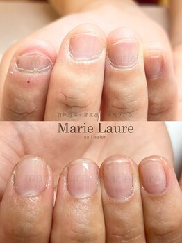 マリーロール 淀屋橋本店(Marie Laure)/自爪育成/深爪矯正/ネイルケア