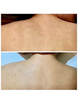 ビビ(VIVI)/背中ニキビケアハーブピーリング