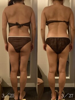 マロー(Mallow)/キャビテーションのビフォアフ