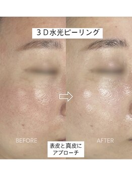 ナルシス(Narcissus)/3d水光ピーリング