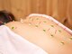 エンカフェサロン(en-cafe salon)の写真/【慢性的な肩首コリ・腰痛でお悩みの方に】ラジオ派+カッピング+お灸+全身鍼で血流を促進,体スッキリ◎