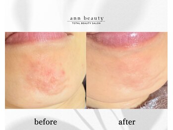 アン ビューティー(ann beauty)/施術4回【症例写真】40代女性