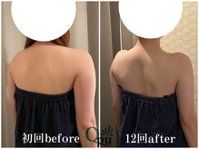 キュープ 福岡天神店(Qpu)/巻き肩コース４回での変化