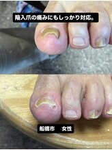 巻き爪じゅん 千葉駅前店/陥入爪の痛みに悩む方へ