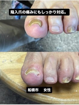 巻き爪じゅん 千葉駅前店/陥入爪の痛みに悩む方へ