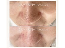 クトナ(Qutona)の雰囲気(ダウンタイムのない優しい施術です◎(お顔のみ・目口元以外))