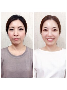 ハナノ整体院/小顔整体2回目