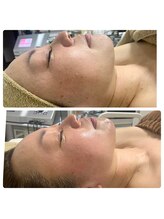 アミューラ(AMULA)/一回目ビフォーアフター◎