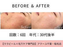 ア クーユ 稲毛店/ララピール/毛穴/ニキビケア美肌