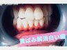 【メンズ】ひげ脱毛＆歯のホワイトニングセットコース　¥6000