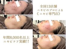 ニキビ研究所 浦和店/年間8000名以上のニキビ改善！