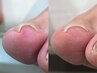 【巻き爪でも快適に♪美しい爪でジェルが楽しめる】フットネイル＋巻き爪ケア