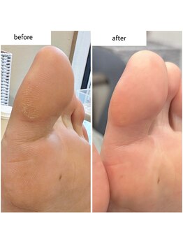 ケアプラス(care plus)/足裏角質ケア