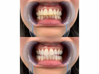 ジーツーホワイトニング 玉造(G2 whitening)/Before After