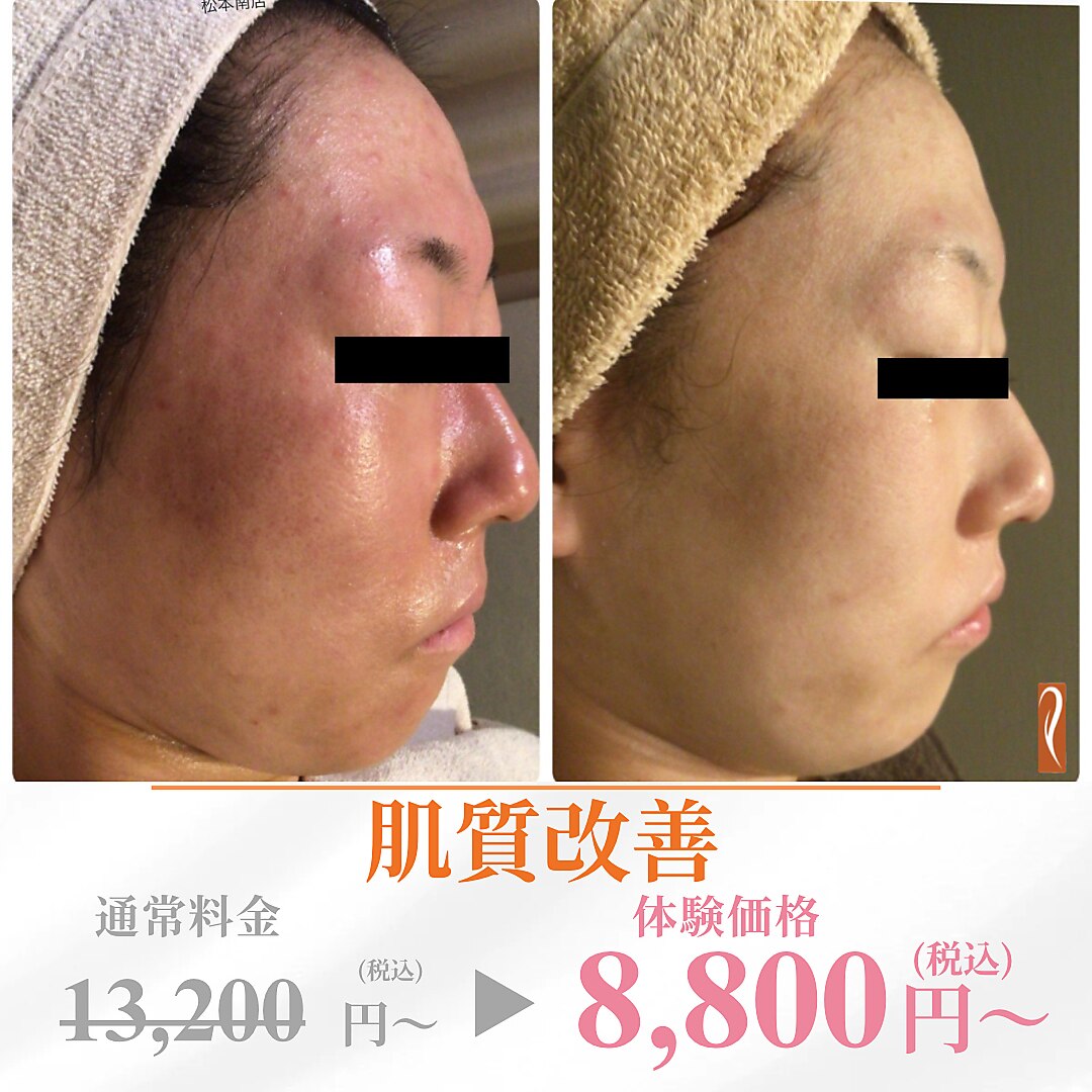 肌質改善エステサロン♡ フォー(For)｜ホットペッパービューティー